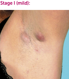 Hidradenitis Suppurativa Hs Symptoms Do I Have Hs