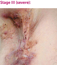 Hidradenitis Suppurativa Hs Symptoms Do I Have Hs