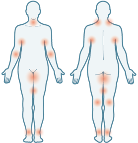 Where hidradenitis suppurativa (HS) symptoms appear on the body illustration