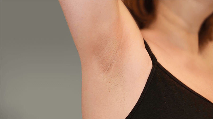 After HUMIRA: Picture of moderate hidradenitis suppurativa (HS) on a female’s armpit