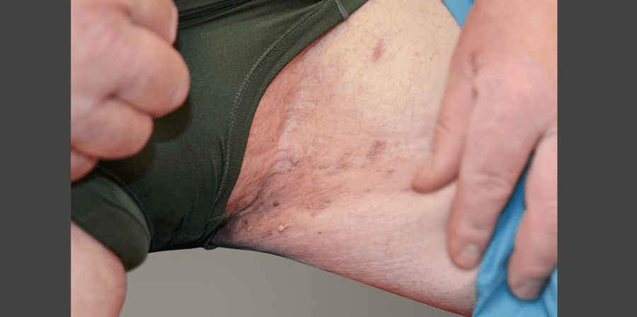 After HUMIRA: Picture of severe hidradenitis suppurativa (HS) on a male’s inner thigh and groin armpit