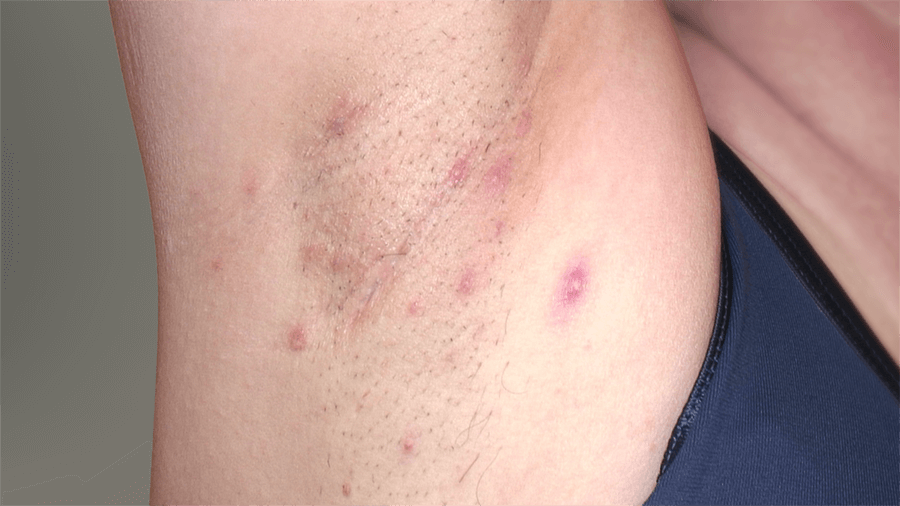 Armpit symptoms before and after HUMIRA