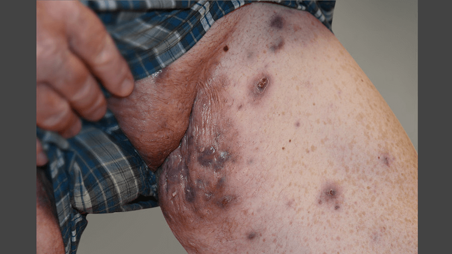 Before HUMIRA: Picture of severe hidradenitis suppurativa (HS) on a male’s inner thigh and groin armpit