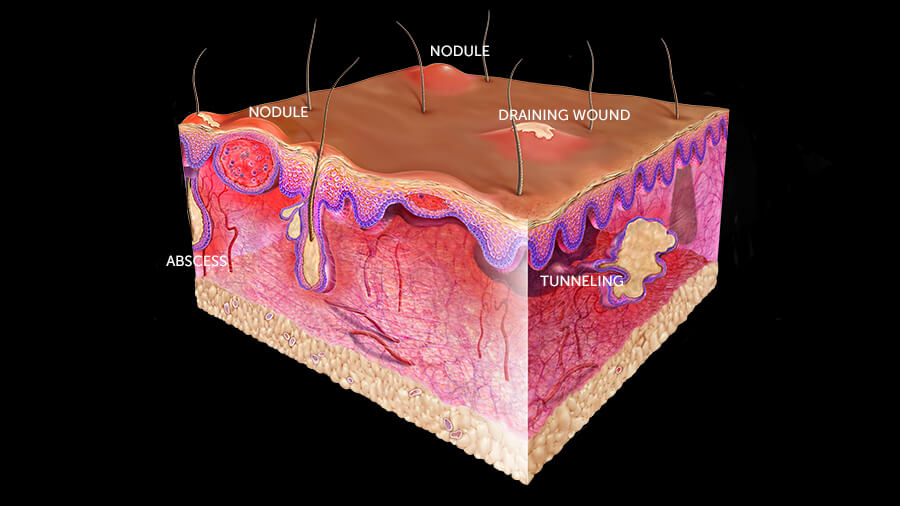 Skin after HUMIRA HS treatment diagram