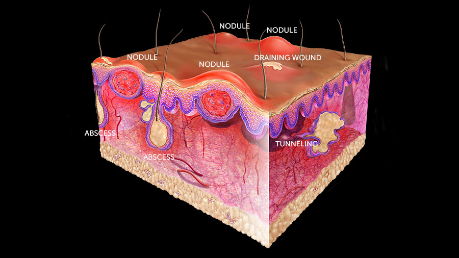 Skin before HUMIRA HS treatment diagram 