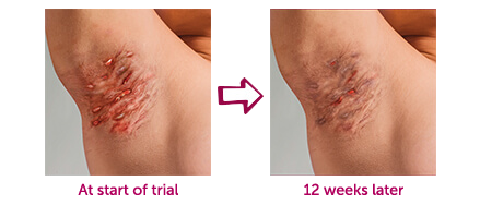 Armpit symptoms before and after starting HUMIRA