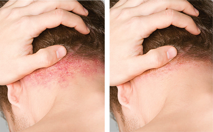 Image of plaque psoriasis before and after