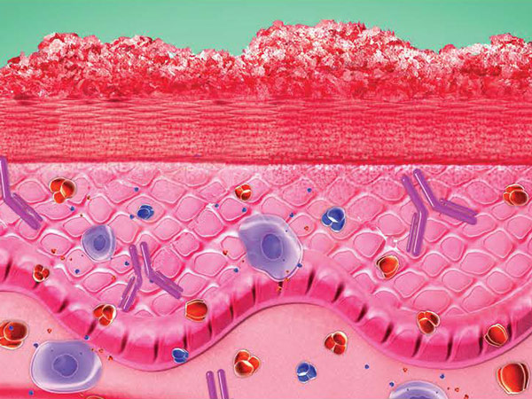 Image of plaque psoriasis under skin