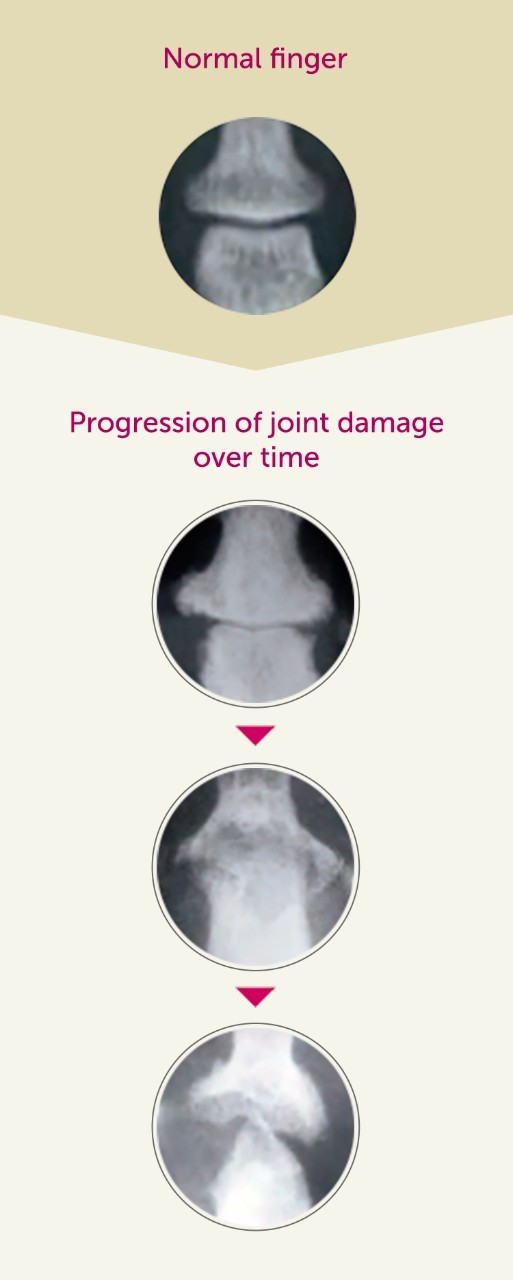Progression of joint damage over time