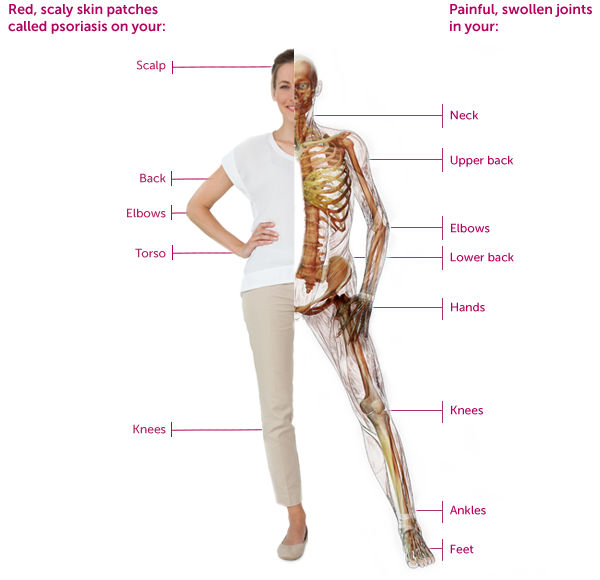 Infographic of Psoriatic Arthritis symptoms outside and inside of a female body