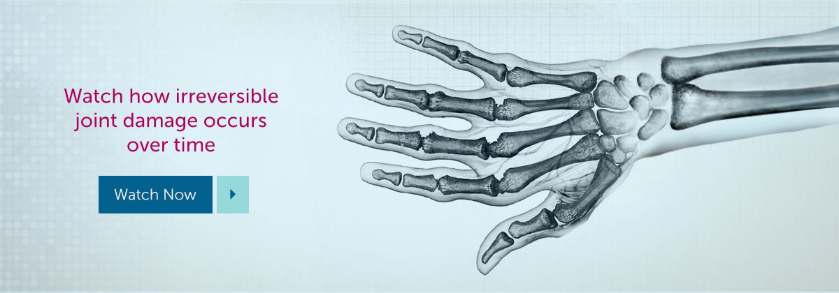 Watch how irreversible joint damage occurs over time