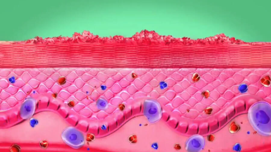 HUMIRA® Plaque Psoriasis Medication How it Works