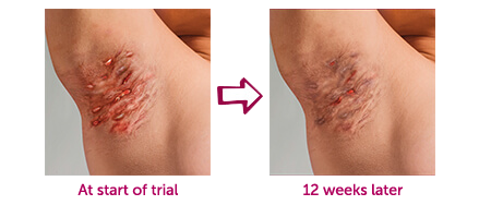 Hidradenitis Suppurativa Hs Treatment Humira Adalimumab